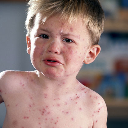 Аллергия у детей: что нужно знать!