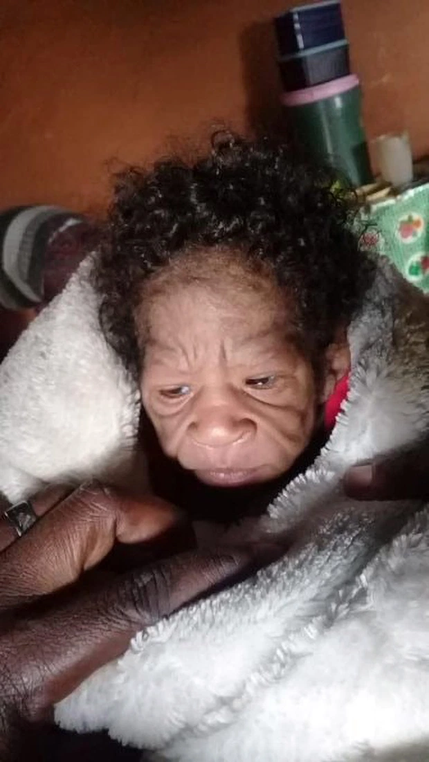 В Африке женщина родила ребенка с «синдромом Бенджамина Баттона»