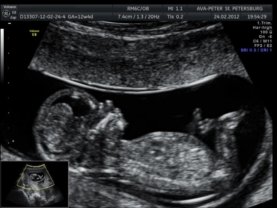 УЗИ. 12 недель беременности фото УЗИ пол ребенка.