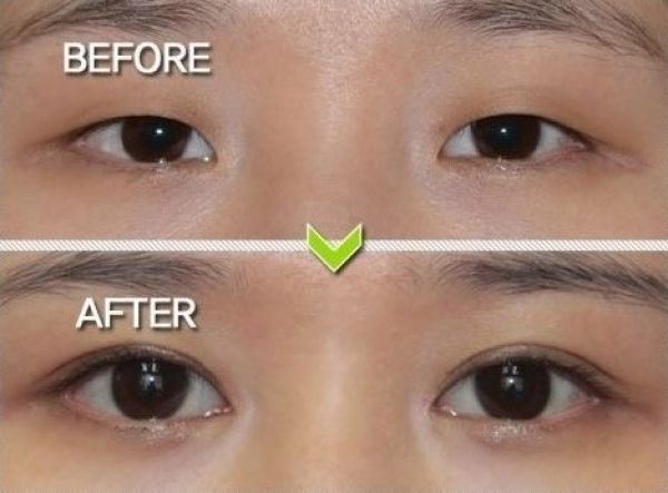 Пластическая хирургия глаз: фото до и после