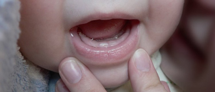 Прорезывание зубов у детей. Появился первый зуб.