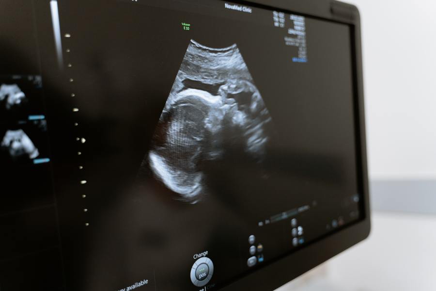 Новый метод диагностики синдрома Дауна начнут проводить на ранних сроках беременности 